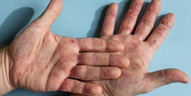 ANSP a confirmat un caz de import de variola maimuței în Republica Moldova. Pacientul este sub supraveghere medicală, iar specialiștii au inițiat ancheta epidemiologică.